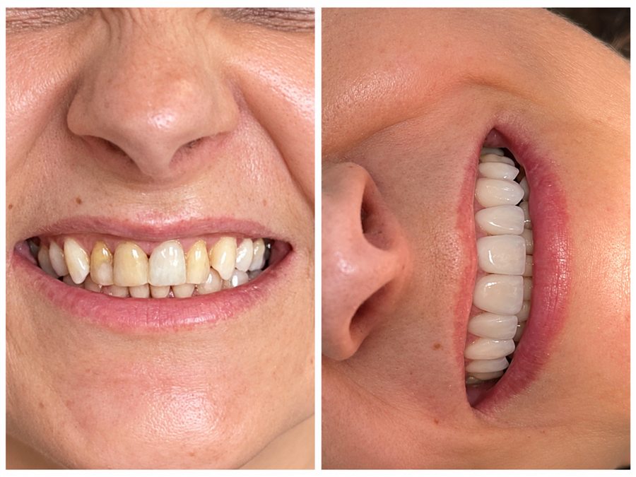 Comparação do sorriso antes e depois do tratamento com lentes de porcelana