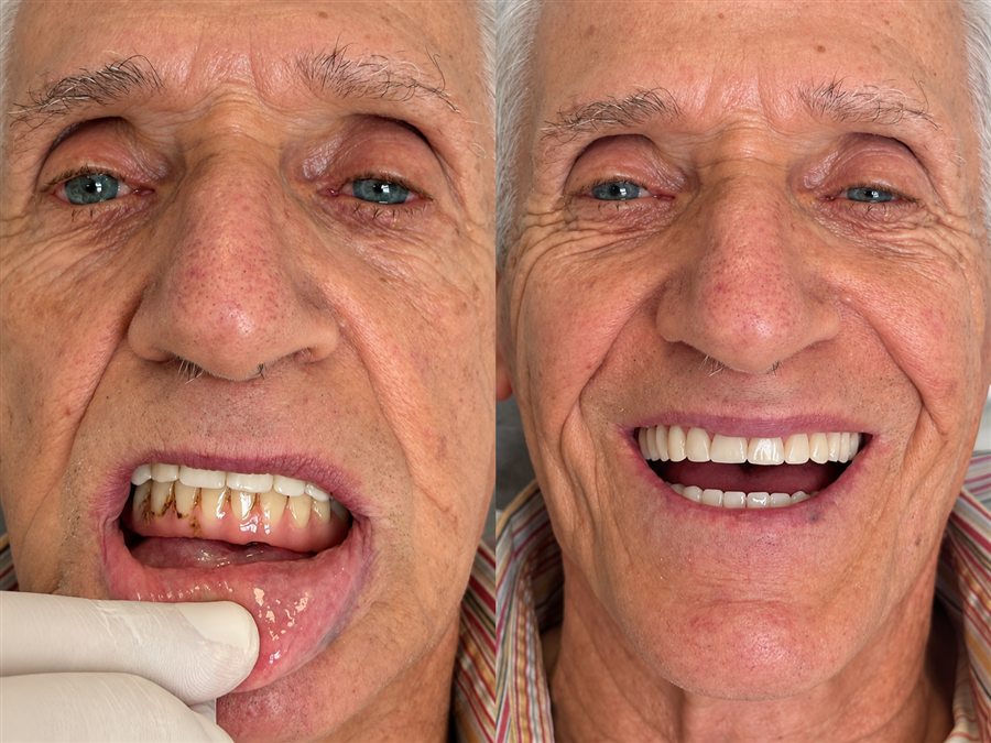 Comparação antes e depois de próteses protocolo sobre implantes nas arcadas superior e inferior