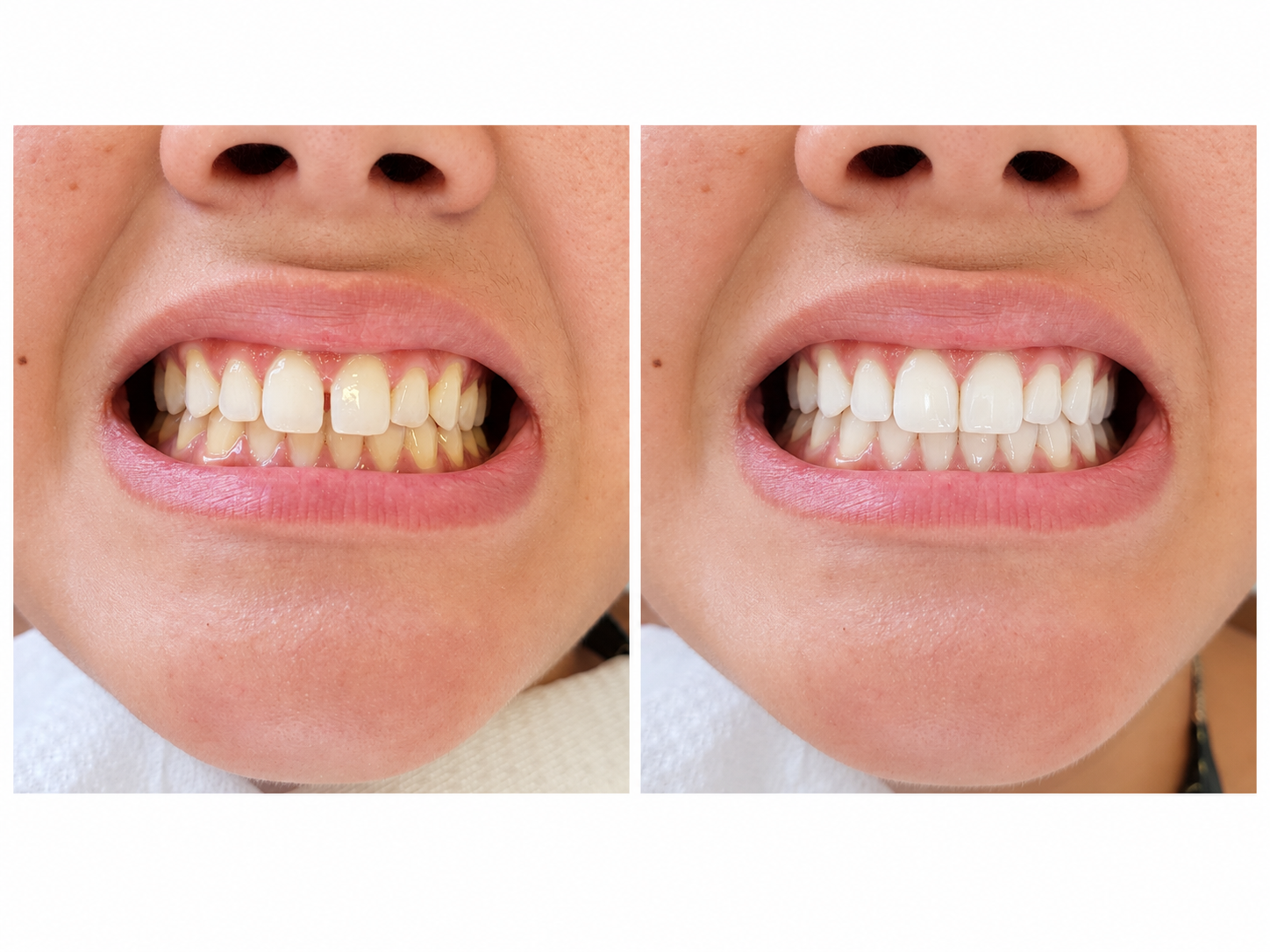 Segunda comparação ortodôntica com a condição inicial à esquerda e a evolução do sorriso à direita
