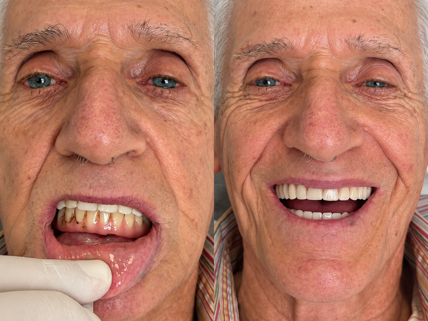 Comparação de prótese protocolo sobre implantes com a condição inicial à esquerda e o sorriso após a reabilitação à direita