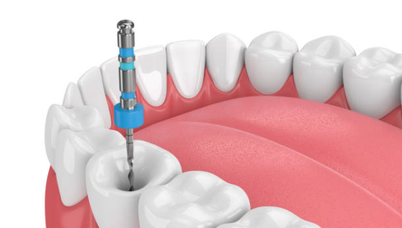Ilustração odontológica de instrumento durante tratamento de canal