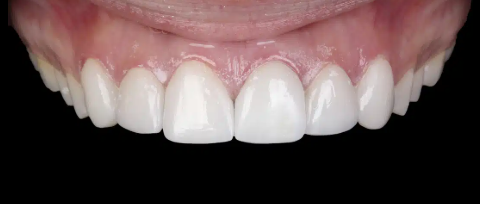 Sorriso ilustrativo com dentes anteriores em destaque