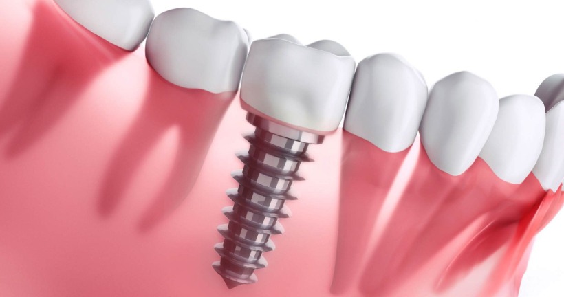 Ilustração odontológica de implante substituindo a raiz de um dente