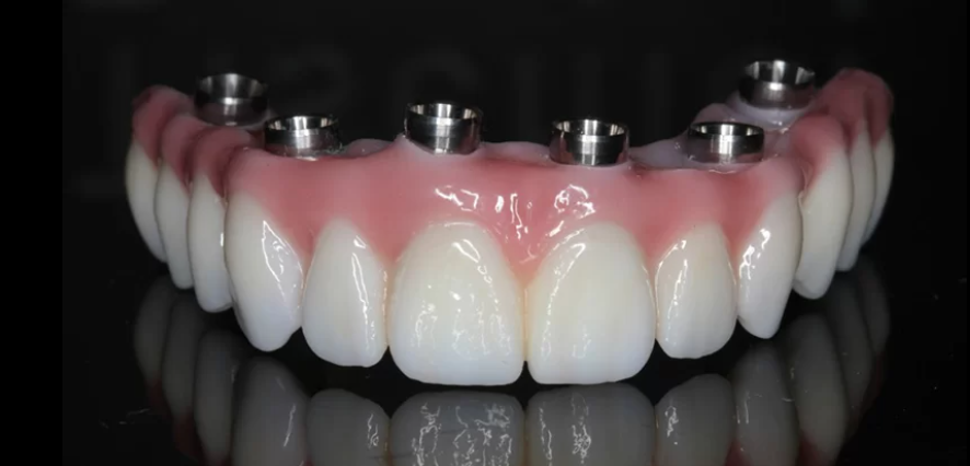 Prótese dentária fixa sobre componentes de implantes